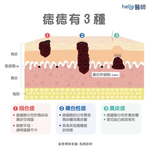 手臂痣長毛代表什麼|痣變大、痣多或長毛會變皮膚癌？認識痣的形成與原因